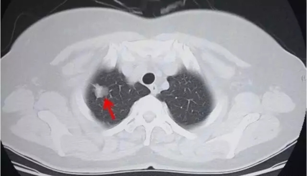 体检胸片没看到什么,ct却发现有肺癌,到底怎么回事?