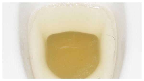 尿液出现3种症状,可能糖尿病"来临"