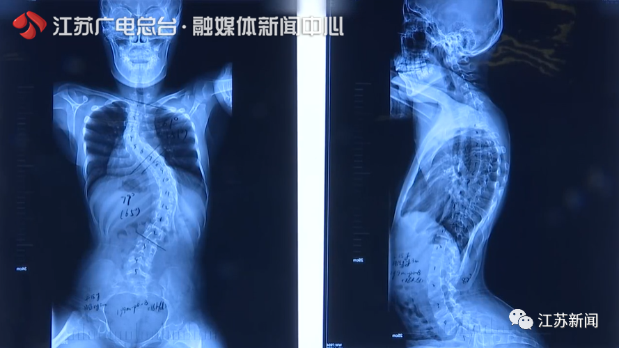 没想到孩子病情很快加重,但没在意,两年前家长发现她胸背部隆起不对称