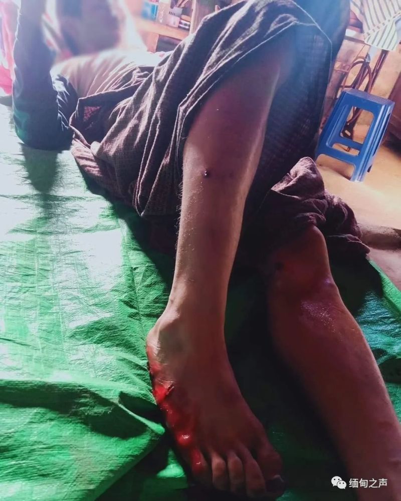 缅甸皎梅镇班林村一村民被地雷炸伤