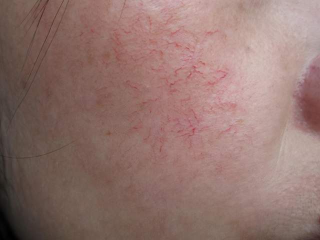 红血丝明显且凸起的原因是什么,如何改善红血丝?