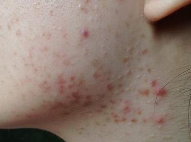 脂肪粒|颈部|淋巴|软纤维瘤