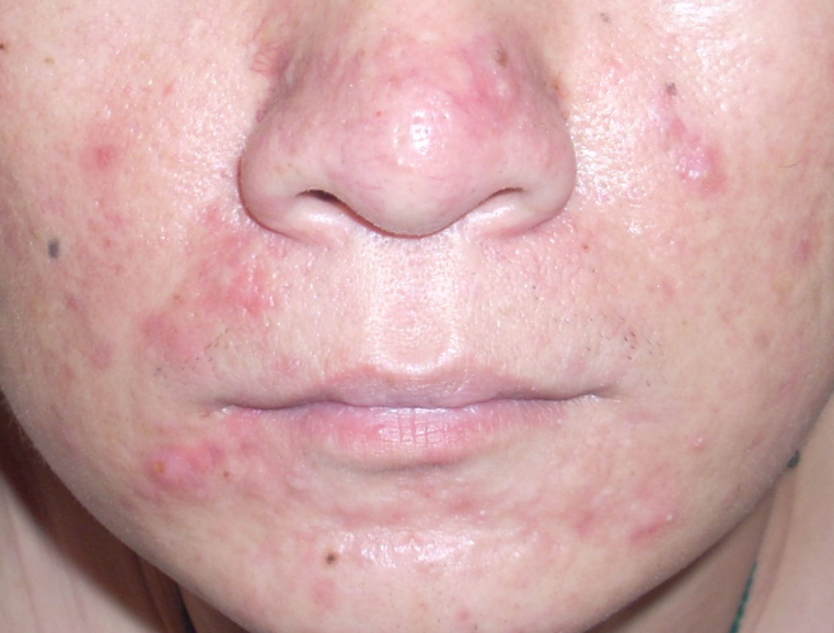 肝炎一旦发生进展,身体4处都有信号