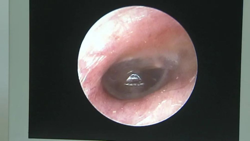 耳内镜检查以后,看到他的鼓膜充血非常明显,虽然没有穿孔,但是鼓膜