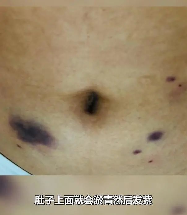妈妈太伟大了宝妈为保胎打500多针肚子多处淤青