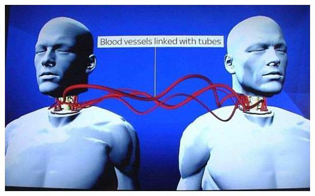 全球首例"换头术"在中国完成,总共花费6000万,结果如何?