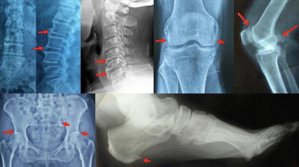 得了骨关节炎有什么好办法?怎么让骨刺不再长?_腾讯新闻