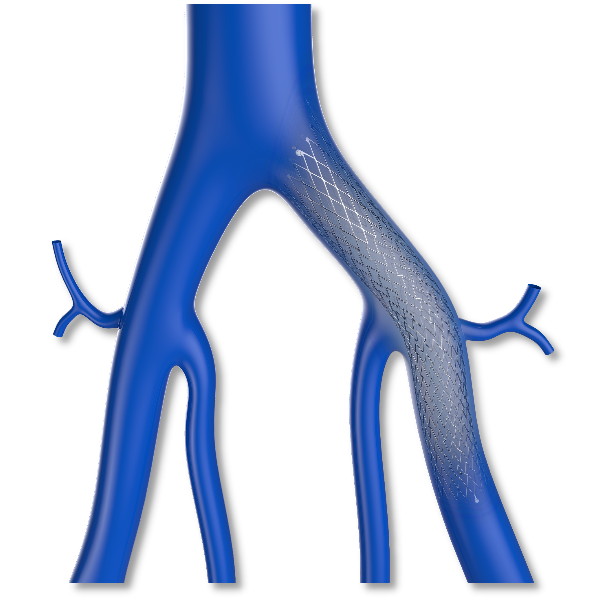 zynlastic静脉支架顺利完成受试者入组
