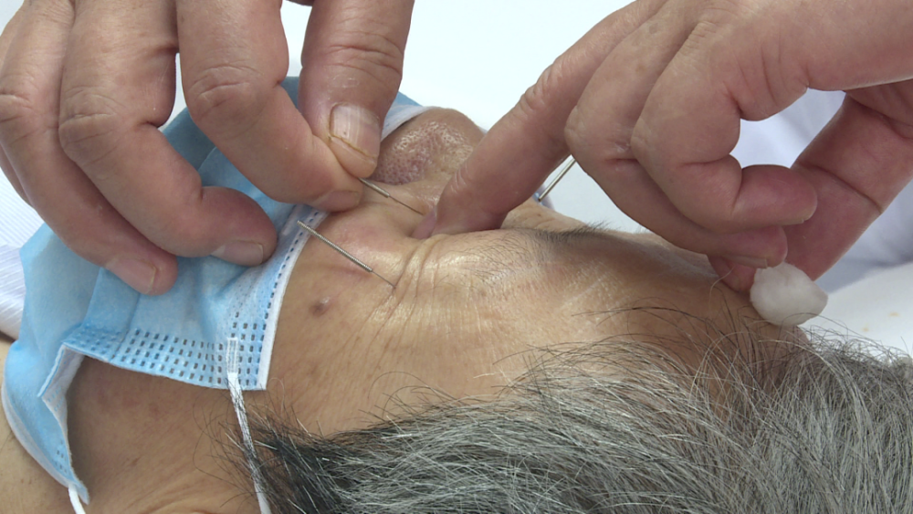 在眼眶周围扎针效果如何看试过的人怎么说