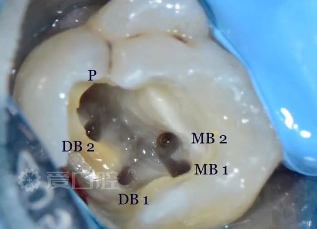 左上第一磨牙5根管治療1例