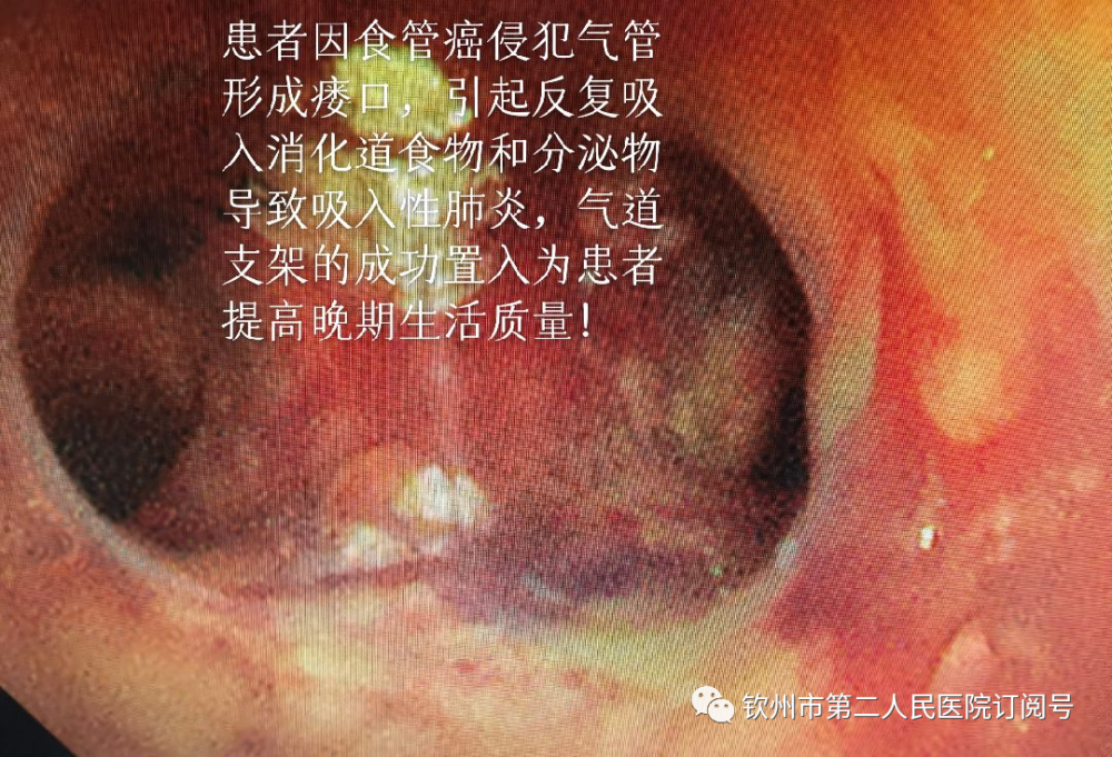 我院呼吸介入團隊成功為氣管食管瘻患者實施瘻口封堵