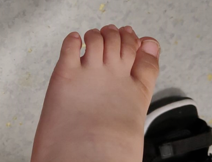 孩子多趾切除手术后能让两只脚完全一模一样吗