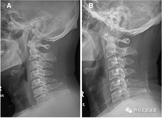 颈椎侧位x线片中易忽视的重要征象