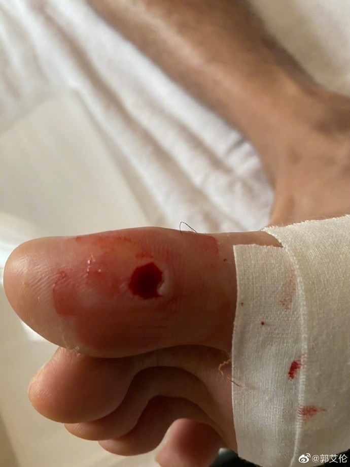 郭艾伦晒脚底伤口照:不打麻药 直接剪肉剪个窟窿_腾讯新闻