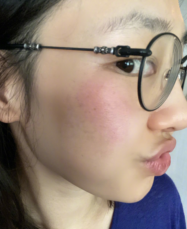 37岁白百何脸部晒伤!晒怼脸自拍脸上一片红,惹粉丝心疼