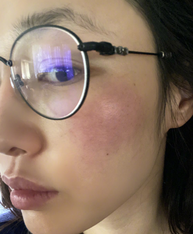 37岁白百何脸部晒伤晒怼脸自拍脸上一片红惹粉丝心疼