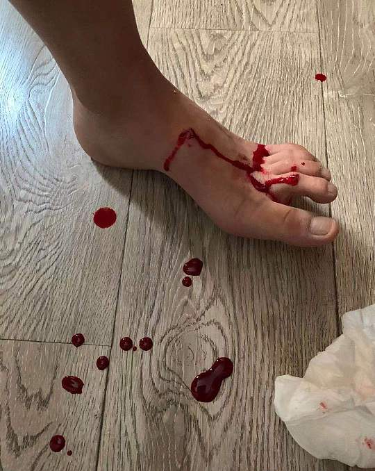 哗啦一声全部溅开了,玻璃颗粒溅到了我身上,手和脚多处被玻璃颗粒