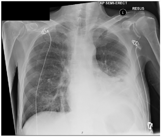 病例 慢性淋巴细胞白血病心脏浸润和冠脉闭塞继发的急性冠脉综合征 腾讯新闻