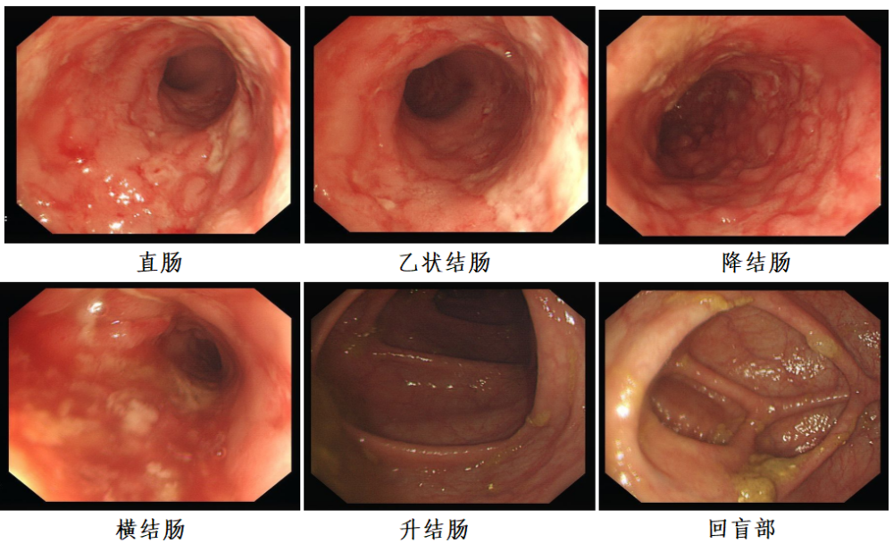 重度肠化 腾讯网