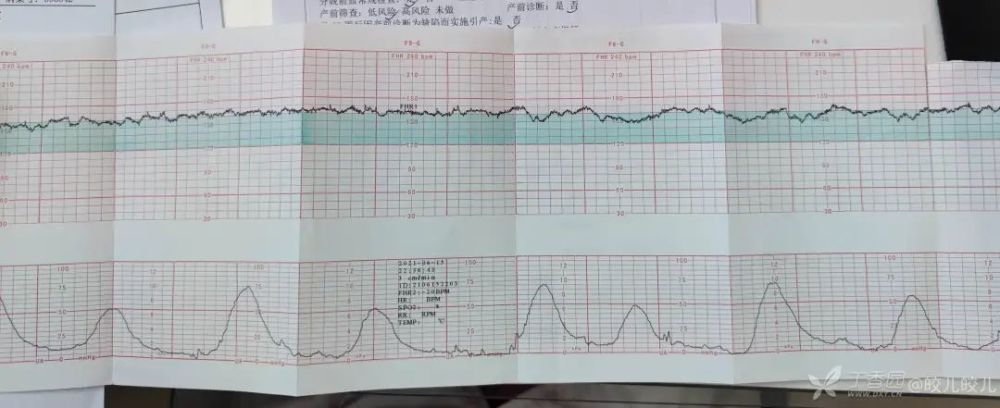 查體:血壓 115 / 70 mmhg,宮高 30 cm,腹圍 102 cm,胎心 156 次/分