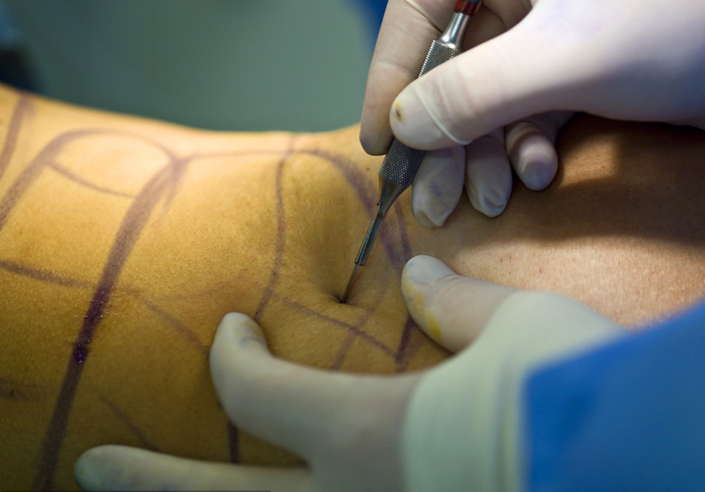 网红抽脂去世涉事医院暂停接诊,抽脂是什么样的手术,安全吗?