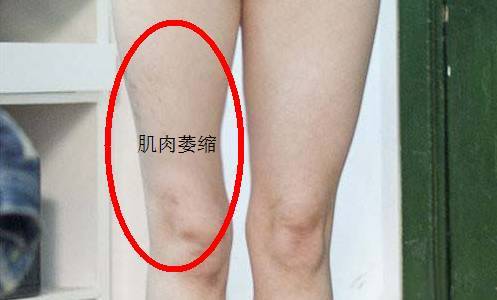 中风瘫痪后出现肌肉萎缩的原因是什么?_腾讯新闻