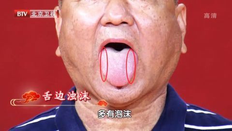 典型症状:舌苔黄腻,舌边有浊沫口中粘腻,口干口苦,胸胁胀满或腹胀,腰