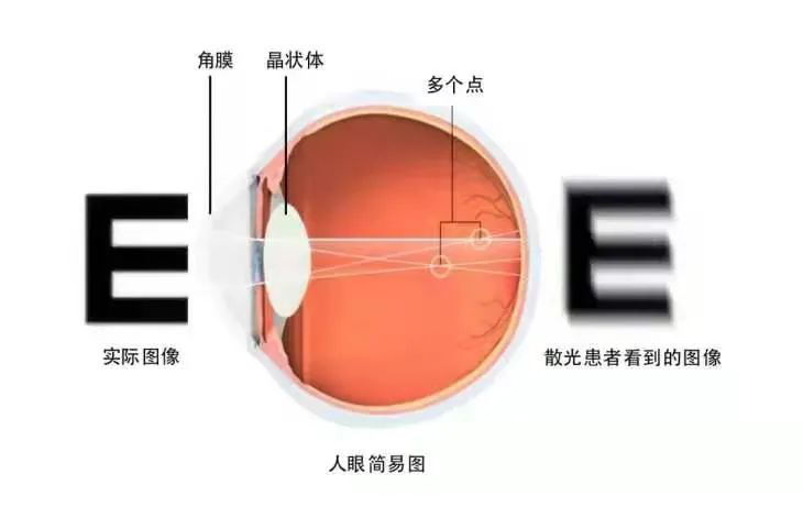 延安市首枚 市中医医院眼科成功植入散光型人工晶体 腾讯新闻