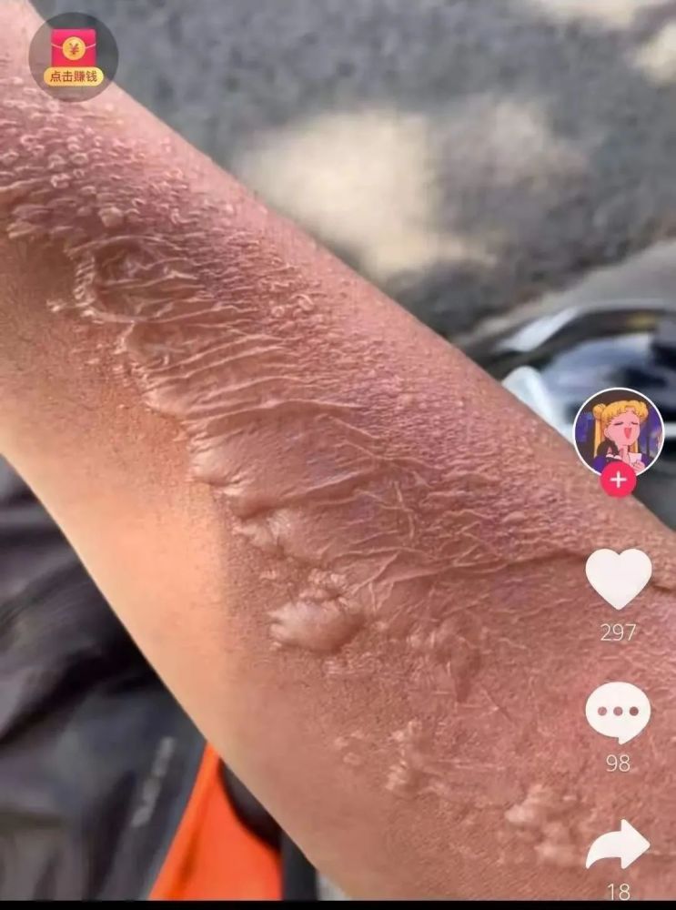 晒爆皮的手臂(耿越毅抖音号)大家都关心的充电问题怎么解决,耿越毅
