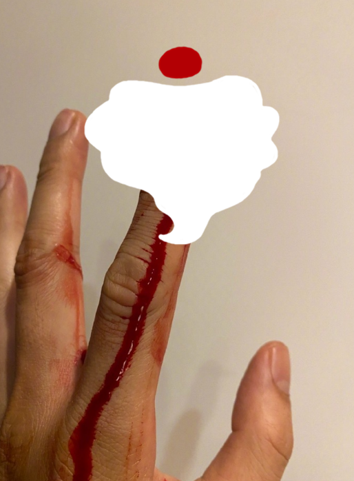 50岁苏见信煮宵夜剁伤手指晒受伤照情况严重凌晨紧急就医