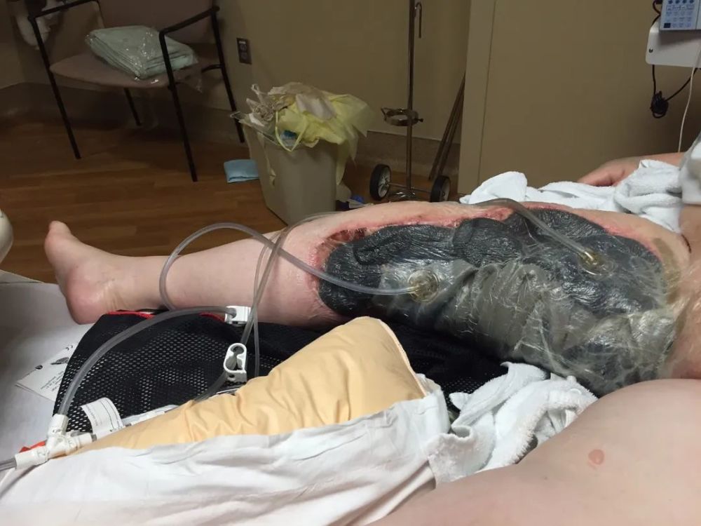 据不完全统计,坏死性筋膜炎的死亡率可高达80%!