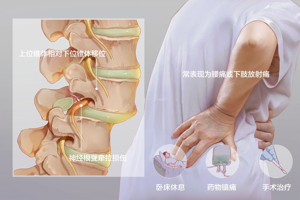 腰椎間盤突出和腰椎滑脫,到底有沒有關係?