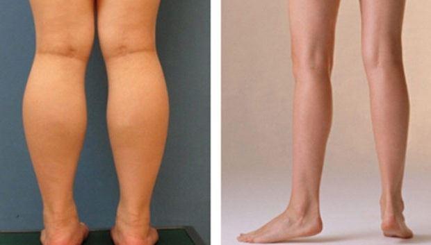 大象腿不好看,怎样摆脱大象腿?我来教你正确的瘦腿方法