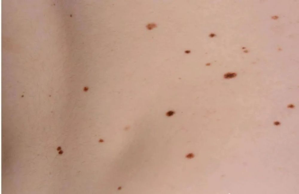 为什么有的人痣多,有的人痣少?关于痣的真相_腾讯新闻