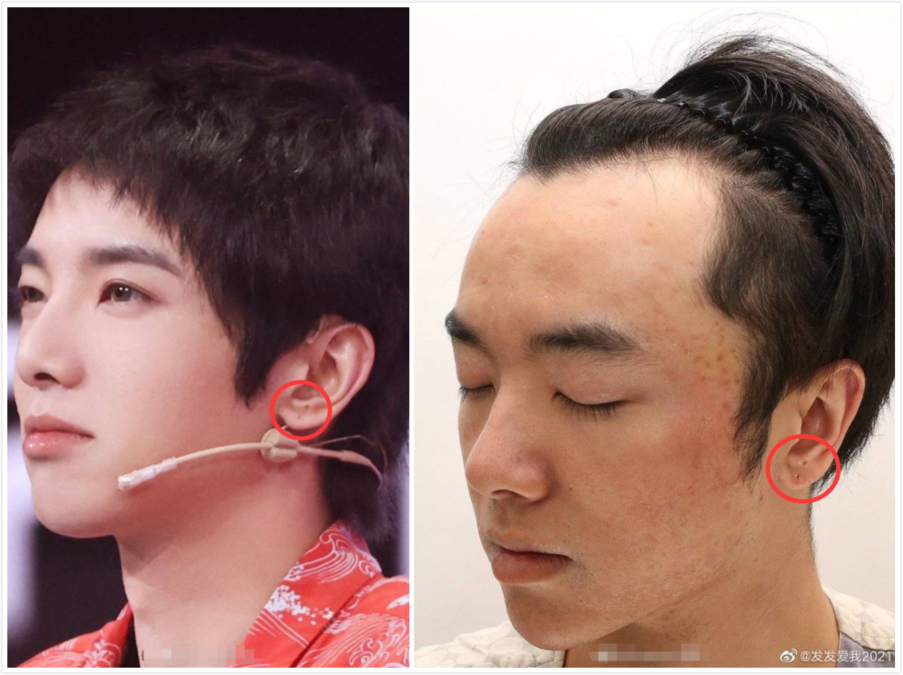 华晨宇被曝整容植发粉丝却称是因皮肤过敏工作室也起诉了对方