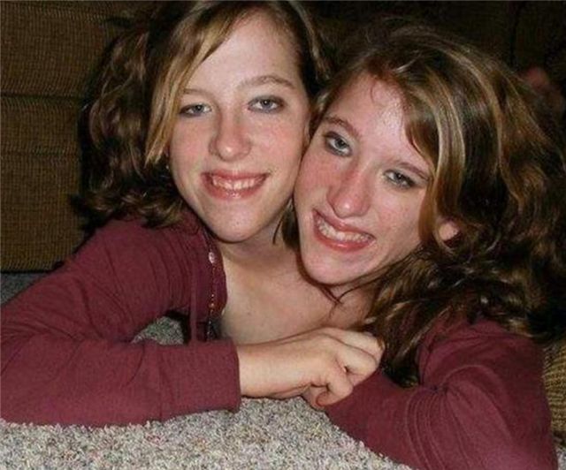 美国双头连体姐妹花姐妹共用同一副身体都有自己的男朋友