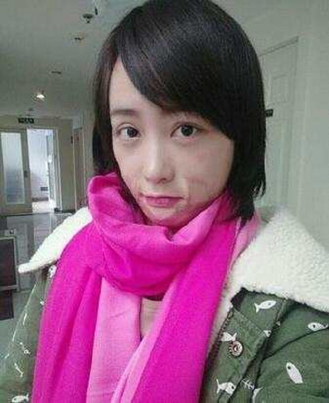 安徽女孩周岩,因拒绝富二代追求被泼汽油,如今走出来了吗?