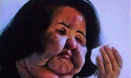 韩国女模特整容上瘾失去理智,注射食用油毁容,面部丑陋异常