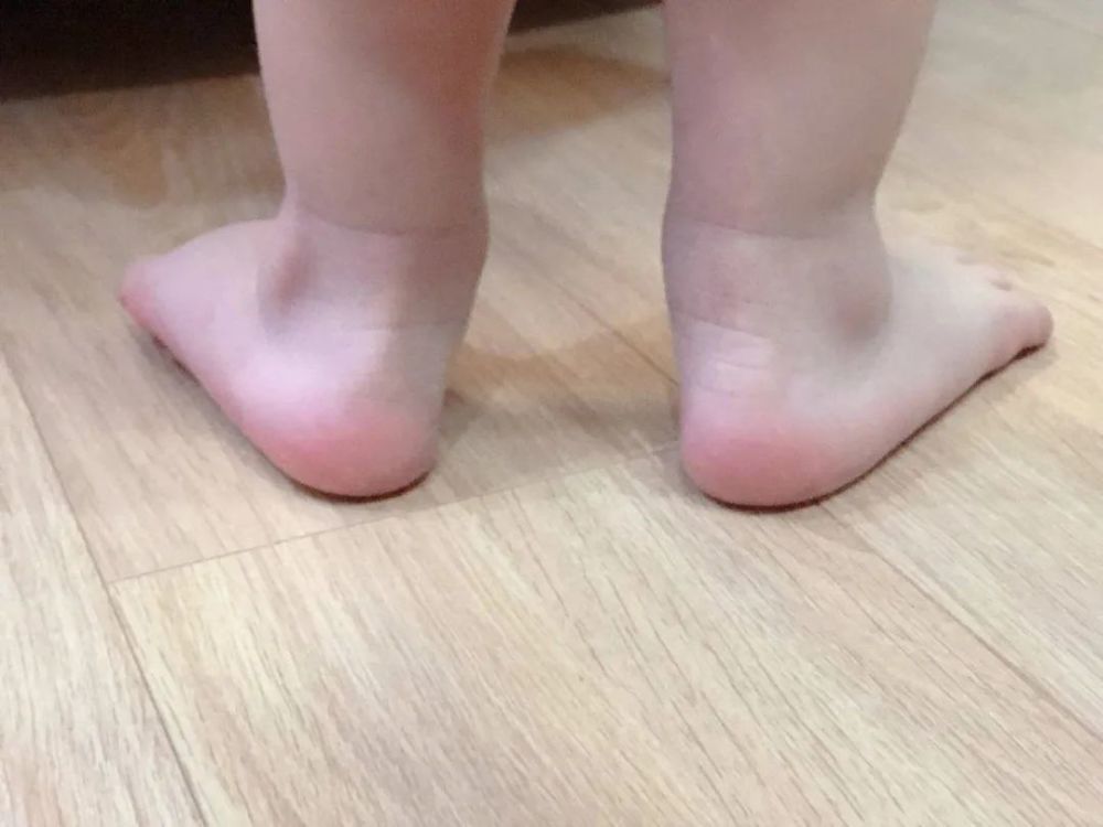 娃的脚疑似扁平足该怎么办