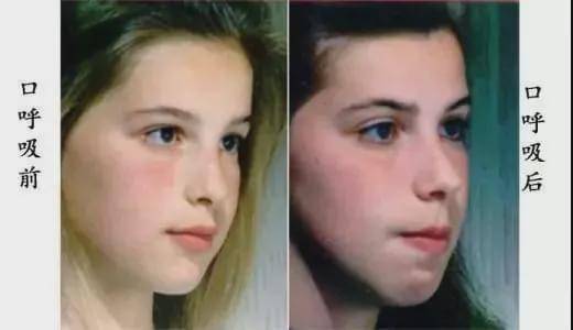 用嘴巴呼吸真的会变丑吗?