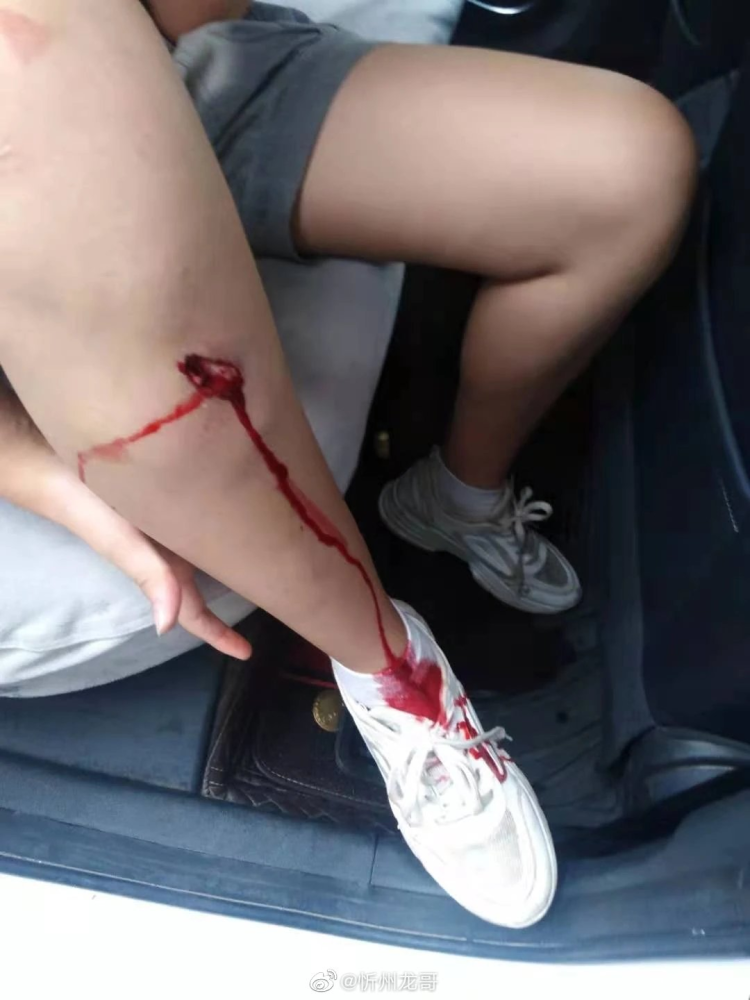 忻州:一女子骑电动车碰到了"梅花桩",腿部受伤……_腾讯新闻