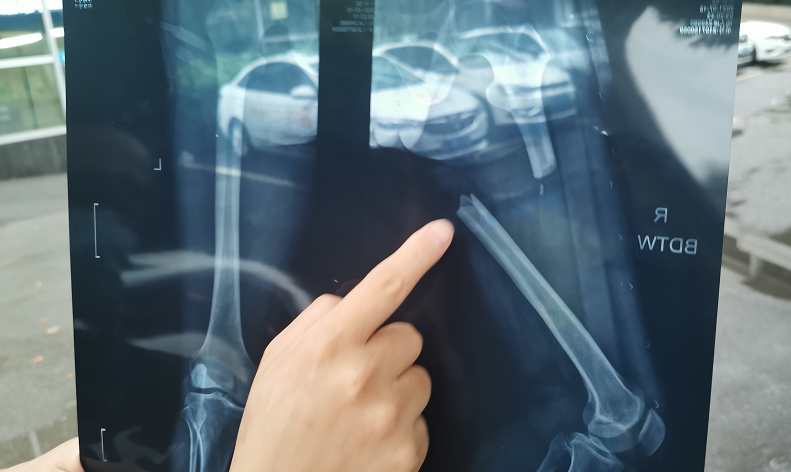 男子腰椎粉碎性骨折,急需这种血型血小板救命!