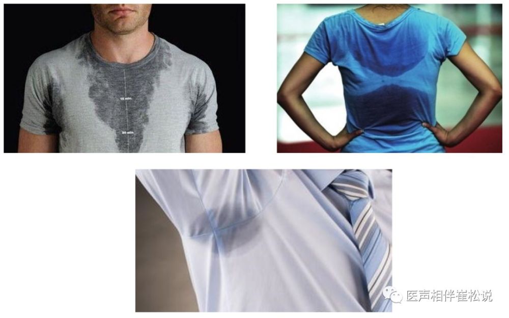 我腋下出汗多!我胸口汗多!我就是背上出汗多!