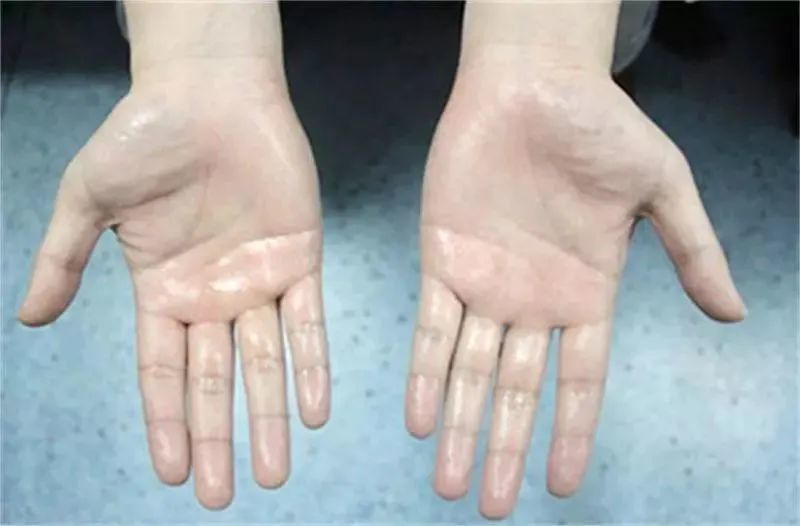 腋汗心窝部和两乳房中间多汗,多因过度思虑而伤心脾.