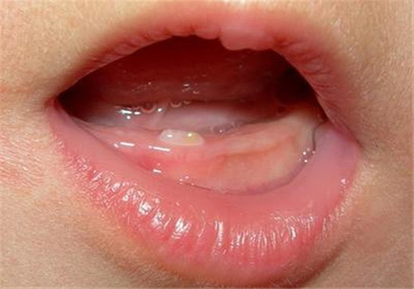 宝宝什么时候出牙才正常?