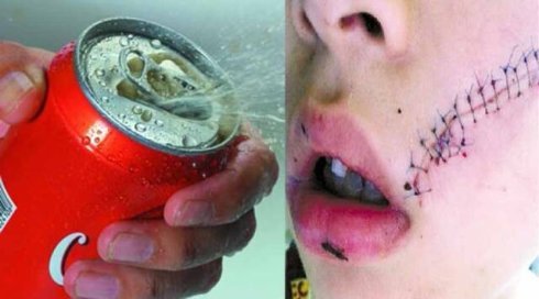 男孩开冰可乐被炸伤缝38针谁来为孩子的安全买单