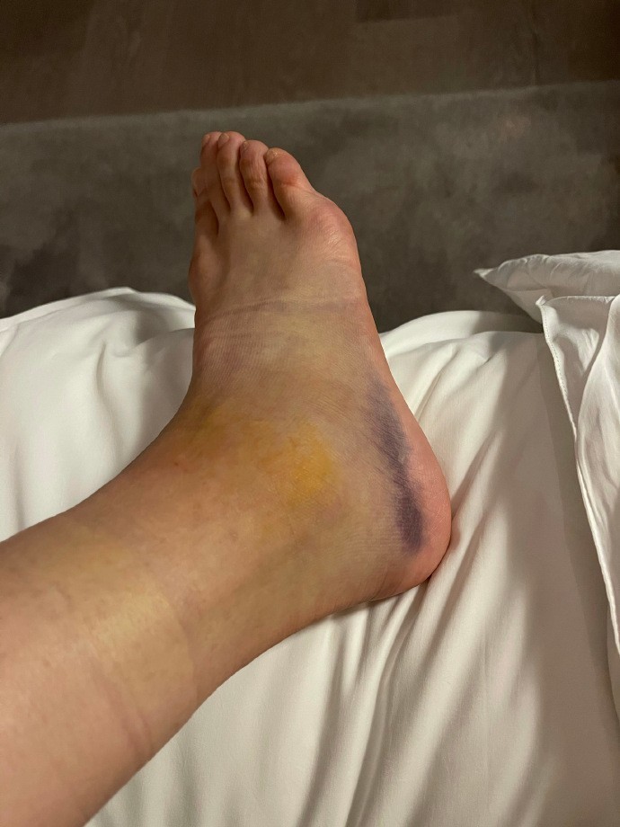 从照片中可以看到,袁咏琳的脚上有非常严重的淤血,黑到发紫,而且脚