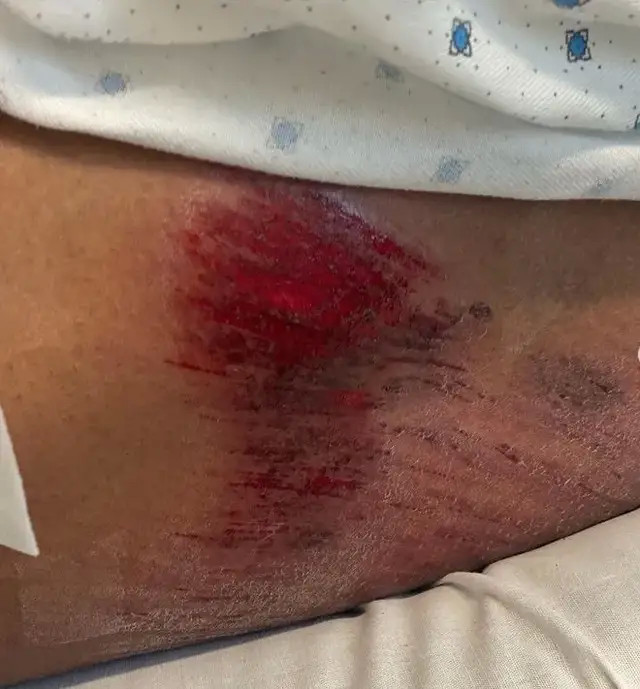 擦伤严重险些晕倒!目前已接受治疗