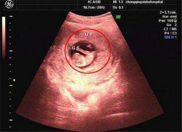 怀孕40天去做b超检查能够查出哪些