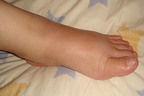 偏瘫病人脚肿是怎么回事?如何才能消肿?